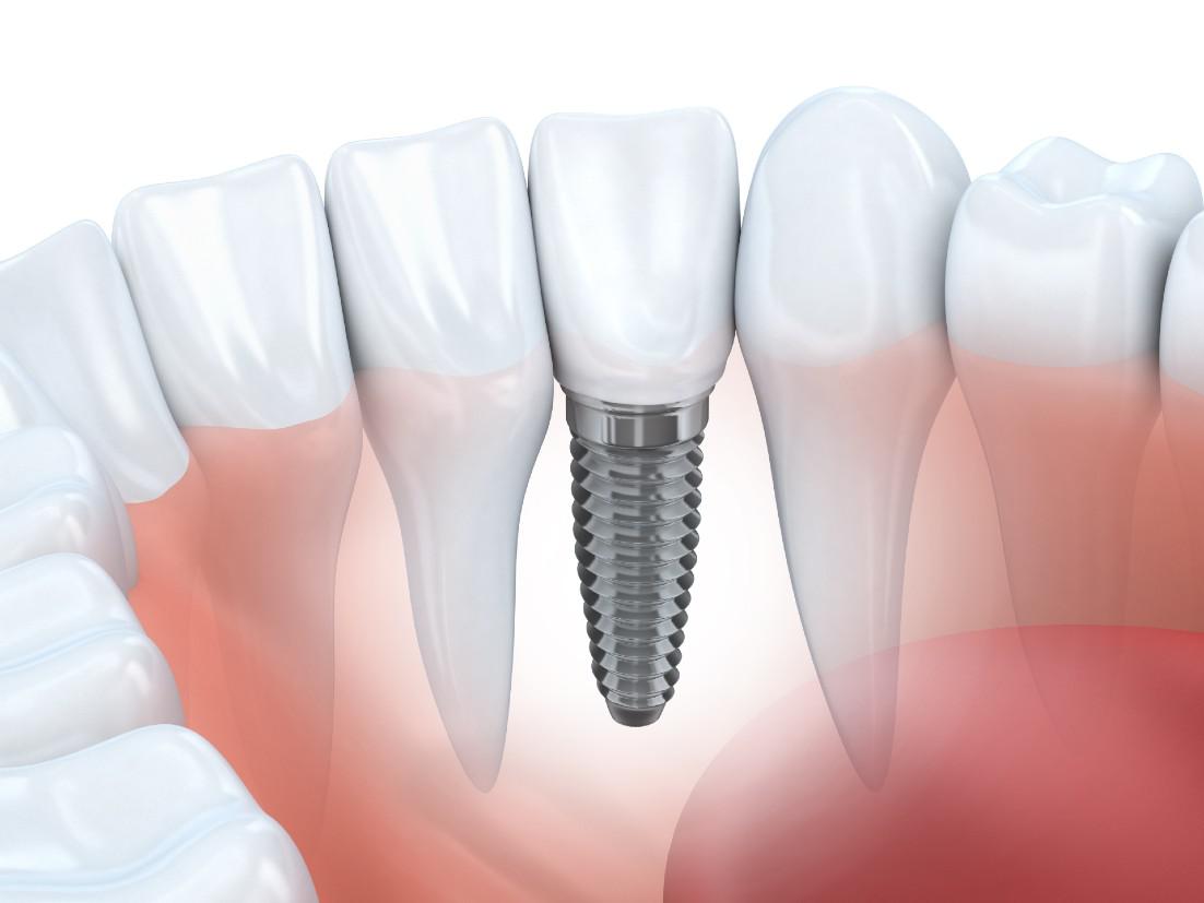 Dental Implants Burke, VA